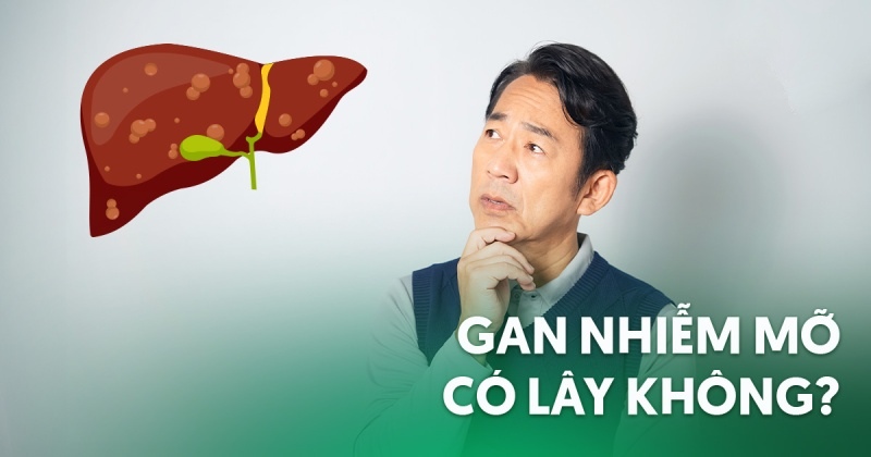 Bệnh gan nhiễm mỡ có lây không? [Chuyên gia giải đáp]