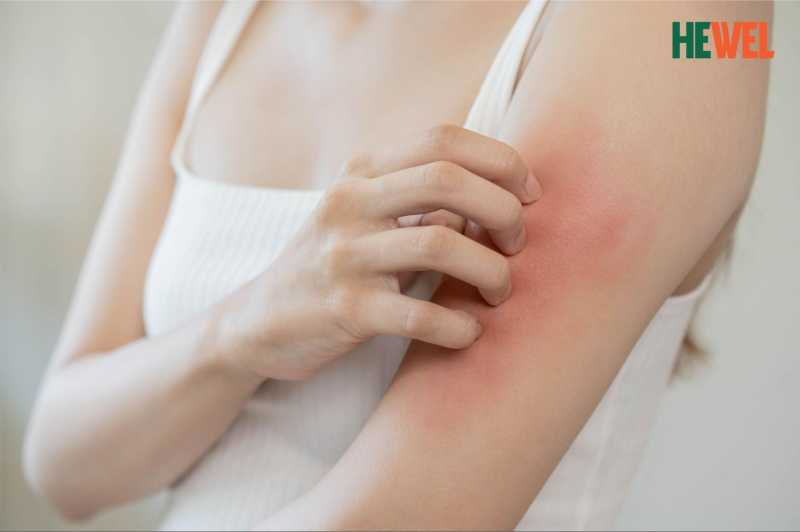 bị dị ứng nổi mày đay