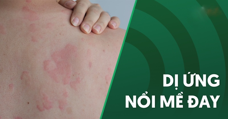 Dị ứng nổi mề đay: Nguyên nhân, triệu chứng và cách phòng ngừa