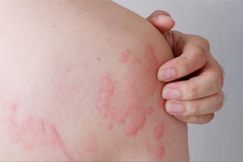 bị mề đay dị ứng
