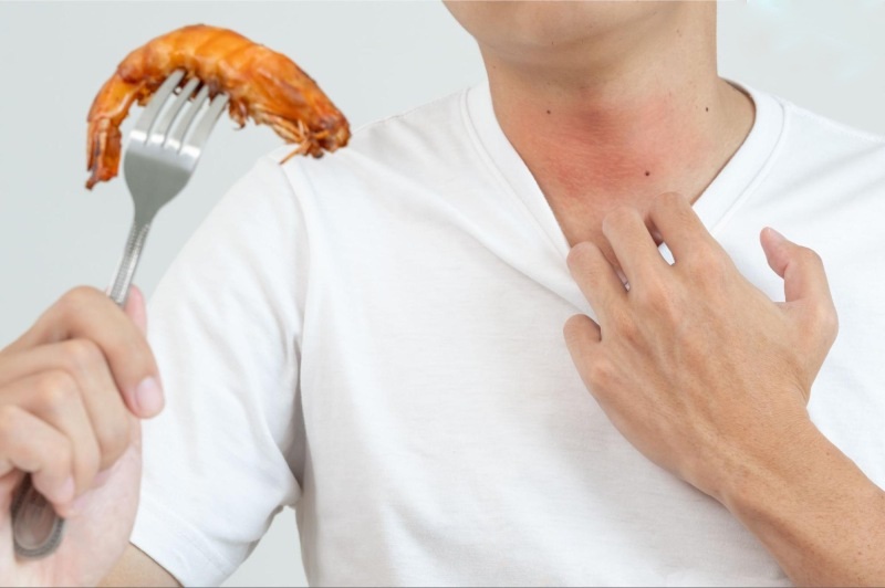 nổi mề đay dị ứng