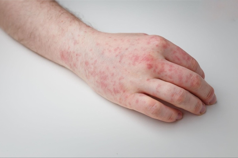 dấu hiệu viêm gan b nổi mẩn ngứa