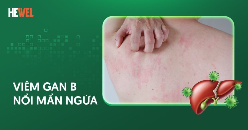Viêm gan B nổi mẩn ngứa: Nguyên nhân, triệu chứng, phòng ngừa