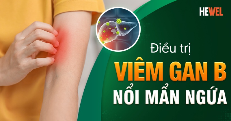 Điều trị viêm gan B nổi mẩn ngứa như thế nào để hiệu quả?