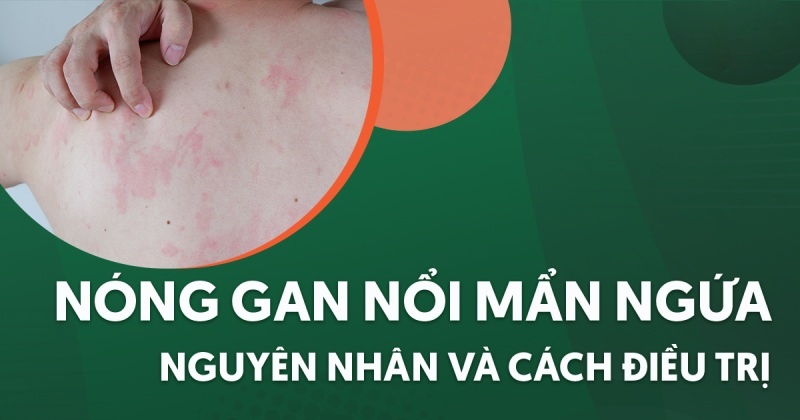 Nóng gan nổi mẩn ngứa: Nguyên nhân, dấu hiệu và cách điều trị