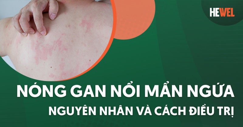 Nóng gan nổi mẩn ngứa: Nguyên nhân, dấu hiệu và cách điều trị
