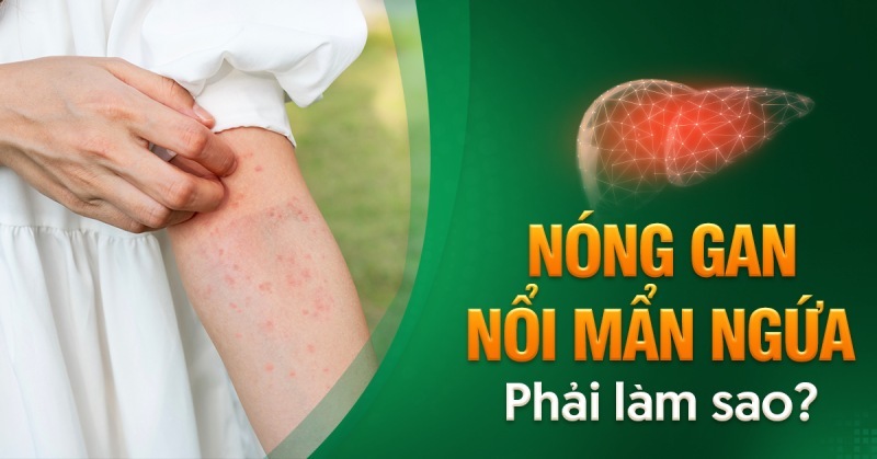 Nóng gan nổi mẩn ngứa phải làm sao? Bao lâu thì đi khám?