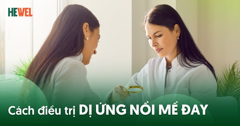 5 cách điều trị dị ứng nổi mề đay hiệu quả, an toàn