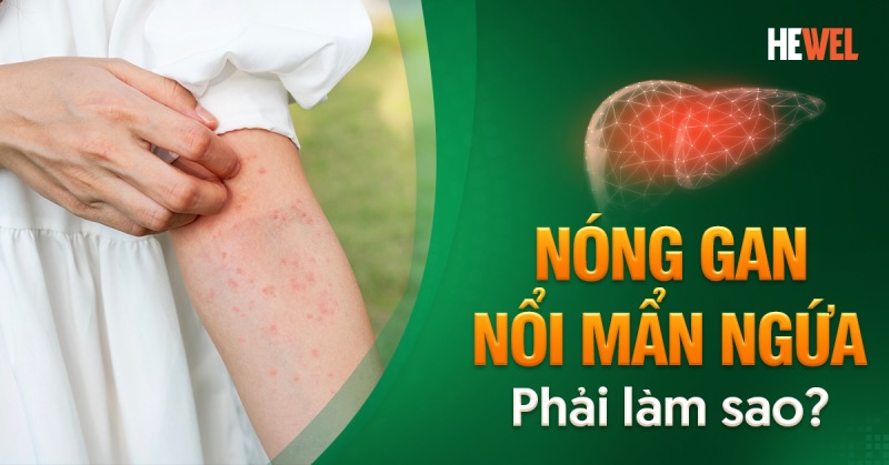 Nóng gan nổi mẩn ngứa phải làm sao? Bao lâu thì đi khám?