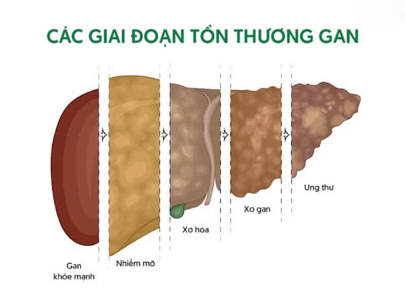 giai đoạn tổn thương gan