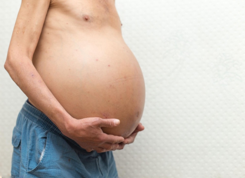 triệu chứng cổ trướng