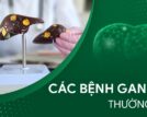 Các bệnh gan mật thường gặp và cách nhận biết