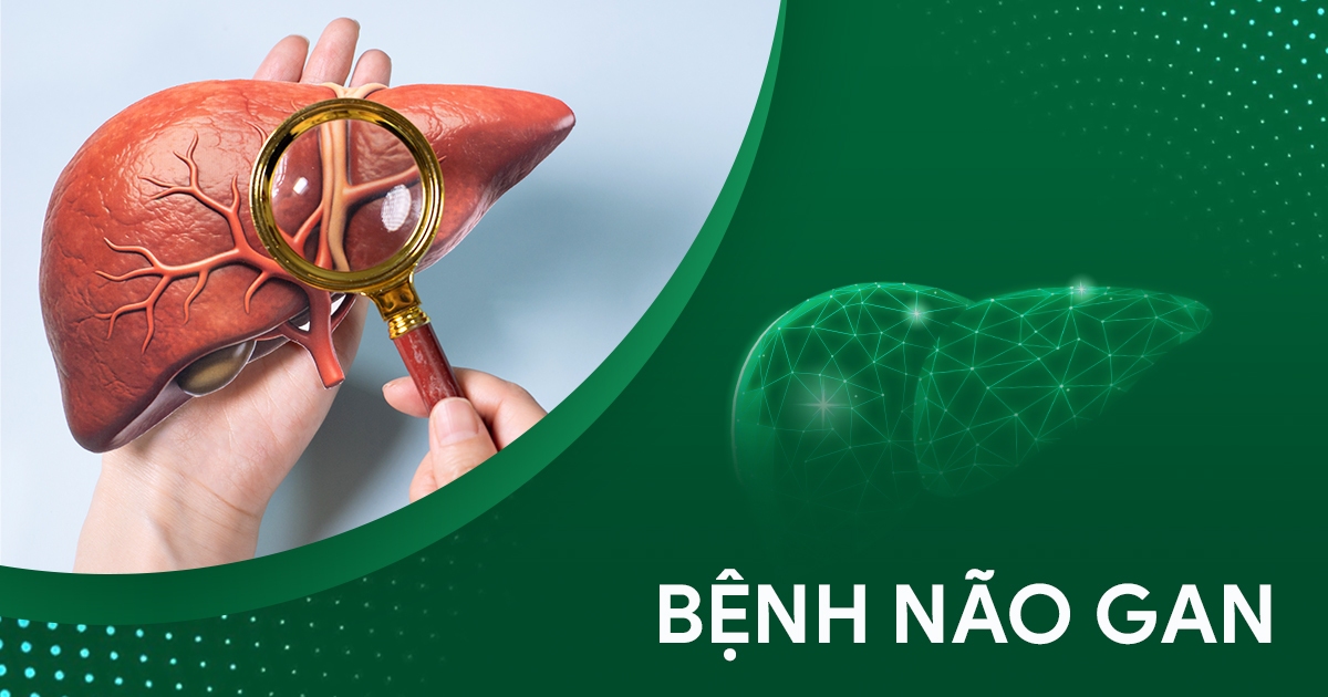 Bệnh não gan (hôn mê gan): Dấu hiệu cảnh báo