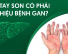 Bàn tay son có phải dấu hiệu bệnh gan?