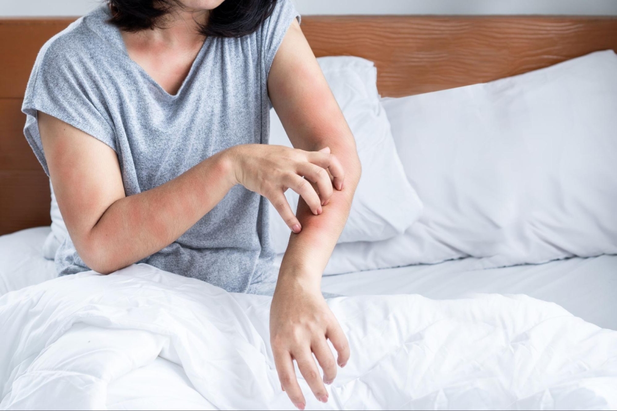 bàn tay son kèm ngứa toàn thân