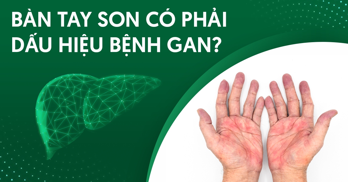 Bàn tay son có phải dấu hiệu bệnh gan?